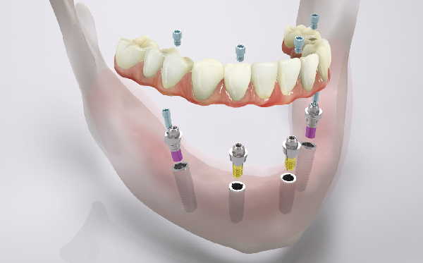 poza implant dentar camlog comfour