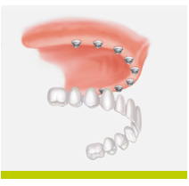 Poză implant dentar coroană fixă
