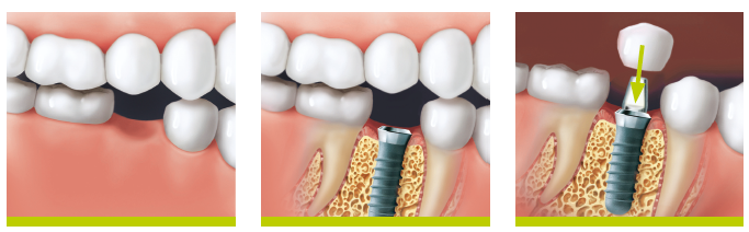 Poză coroană implant dentar