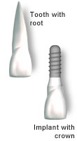Poză implant dentar