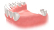 Poză implant dentar mai multi dinti