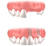 1- foto dinti lipsa inlocuiti cu implant dentar