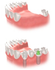 2- foto dinti lipsa inlocuiti cu implant dentar