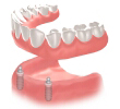 proteza dentara pe ancora retentiva pe implanturi dentare