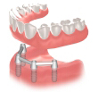 proteza dentara bare pe implanturi dentare
