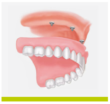 Care Sunt Avantajele Implanturilor Dentare