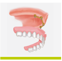 Poză proteză bară implant dentar