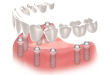 proteaza dentara solida pe implanturi dentare