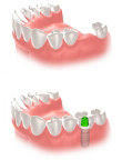 Poză lucrare implant dentar dinte lateral